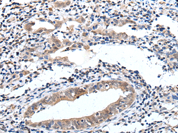 Immunohistochemistry of paraffin-embedded Human cervical cancer tissue  using ELMO1 Polyclonal Antibody at dilution of 1:40(×200)
