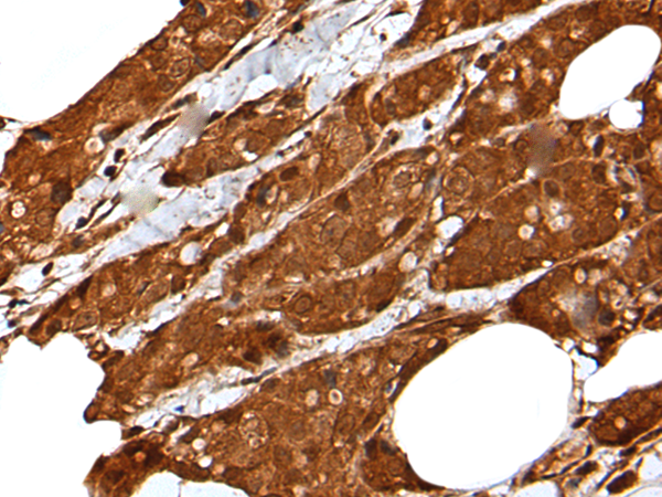 Immunohistochemistry of paraffin-embedded Human breast cancer tissue  using LIPG Polyclonal Antibody at dilution of 1:50(×200)