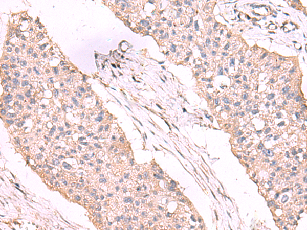 Immunohistochemistry of paraffin-embedded Human esophagus cancer tissue  using ESM1 Polyclonal Antibody at dilution of 1:55(×200)