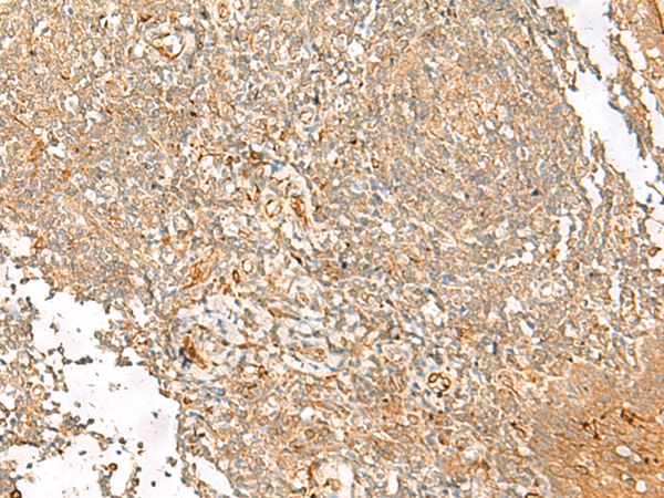 Immunohistochemistry of paraffin-embedded Human tonsil tissue  using FGL2 Polyclonal Antibody at dilution of 1:45(×200)