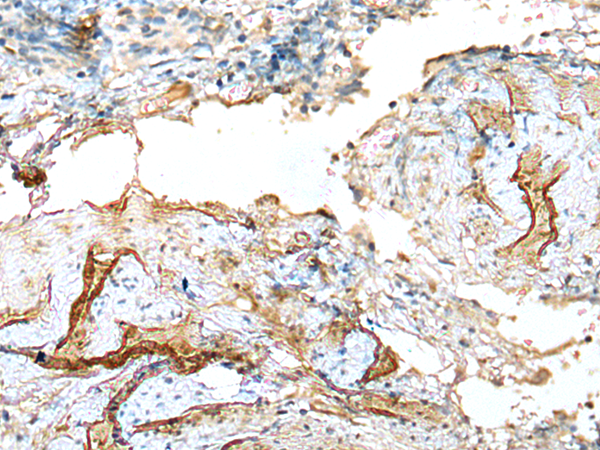 Immunohistochemistry of paraffin-embedded Human cervical cancer tissue  using LDHD Polyclonal Antibody at dilution of 1:120(×200)
