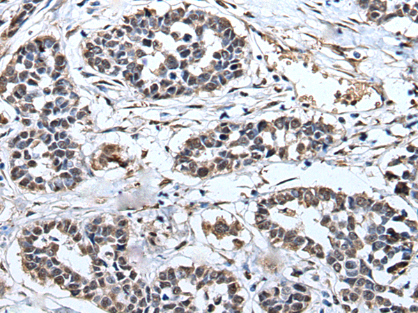 Immunohistochemistry of paraffin-embedded Human esophagus cancer tissue  using PRUNE Polyclonal Antibody at dilution of 1:40(×200)