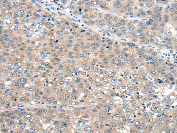 Immunohistochemistry of paraffin-embedded Human liver cancer tissue  using SEMA4D Polyclonal Antibody at dilution of 1:60(×200)
