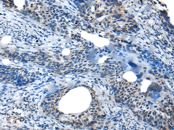 Immunohistochemistry of paraffin-embedded Human cervical cancer tissue  using SAA4 Polyclonal Antibody at dilution of 1:35(×200)