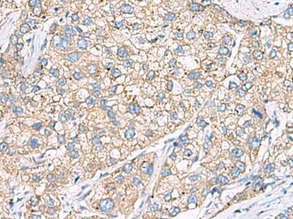 Immunohistochemistry of paraffin-embedded Human liver cancer tissue  using SHC3 Polyclonal Antibody at dilution of 1:40(×200)