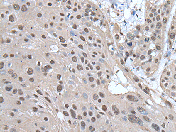 Immunohistochemistry of paraffin-embedded Human esophagus cancer tissue  using HELLS Polyclonal Antibody at dilution of 1:65(×200)