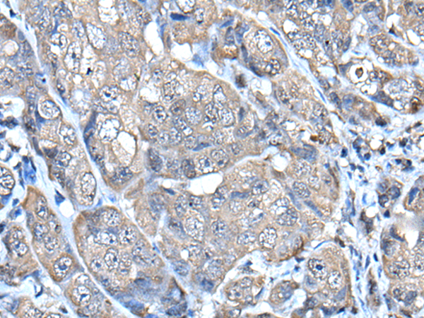 Immunohistochemistry of paraffin-embedded Human breast cancer tissue  using HELLS Polyclonal Antibody at dilution of 1:65(×200)