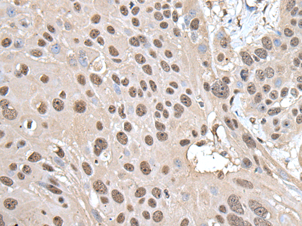 Immunohistochemistry of paraffin-embedded Human esophagus cancer tissue  using SMC1A Polyclonal Antibody at dilution of 1:30(×200)