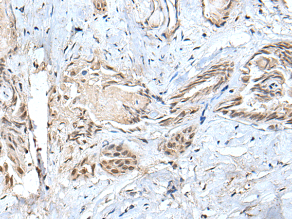 Immunohistochemistry of paraffin-embedded Human thyroid cancer tissue  using SMC1A Polyclonal Antibody at dilution of 1:30(×200)