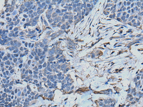 Immunohistochemistry of paraffin-embedded Human thyroid cancer tissue  using TPT1 Polyclonal Antibody at dilution of 1:45(×200)