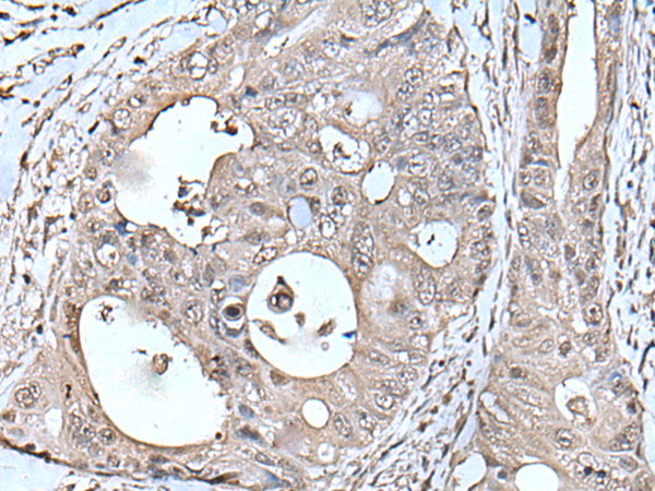 Immunohistochemistry of paraffin-embedded Human colorectal cancer tissue  using TPT1 Polyclonal Antibody at dilution of 1:45(×200)