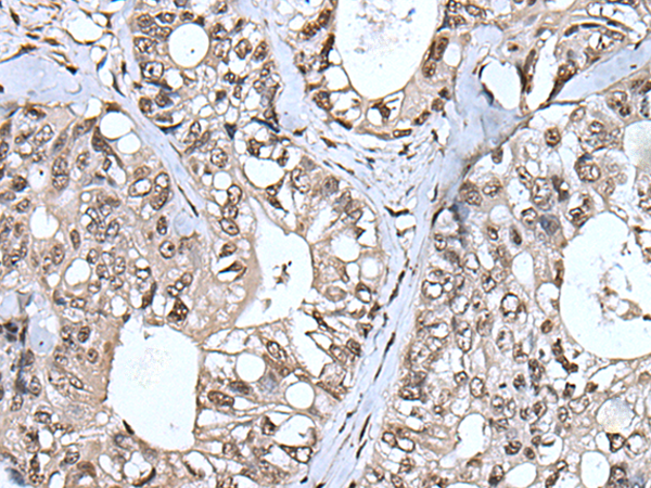 Immunohistochemistry of paraffin-embedded Human colorectal cancer tissue  using TIA1 Polyclonal Antibody at dilution of 1:55(×200)