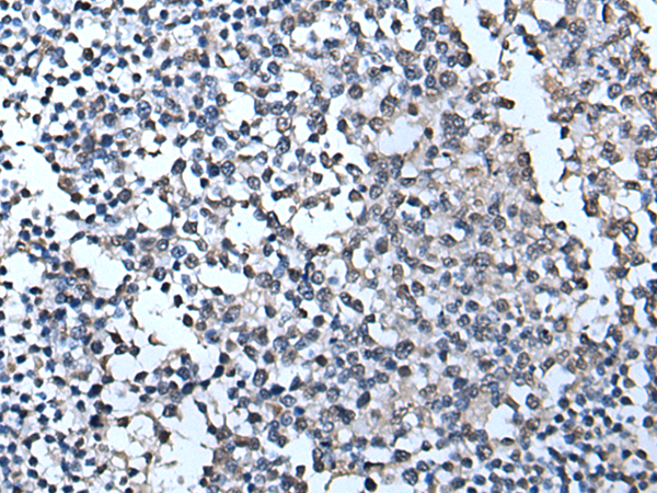 Immunohistochemistry of paraffin-embedded Human tonsil tissue  using TIA1 Polyclonal Antibody at dilution of 1:55(×200)