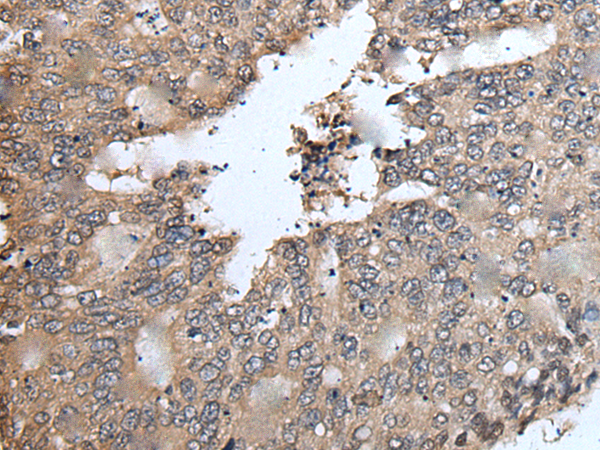 Immunohistochemistry of paraffin-embedded Human colorectal cancer tissue  using TRIM23 Polyclonal Antibody at dilution of 1:55(×200)