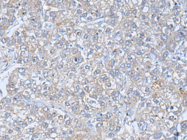 Immunohistochemistry of paraffin-embedded Human liver cancer tissue  using TREM1 Polyclonal Antibody at dilution of 1:50(×200)