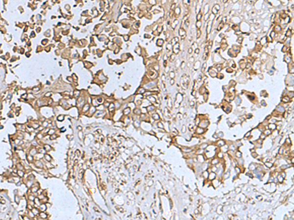 Immunohistochemistry of paraffin-embedded Human colorectal cancer tissue  using TREM1 Polyclonal Antibody at dilution of 1:50(×200)