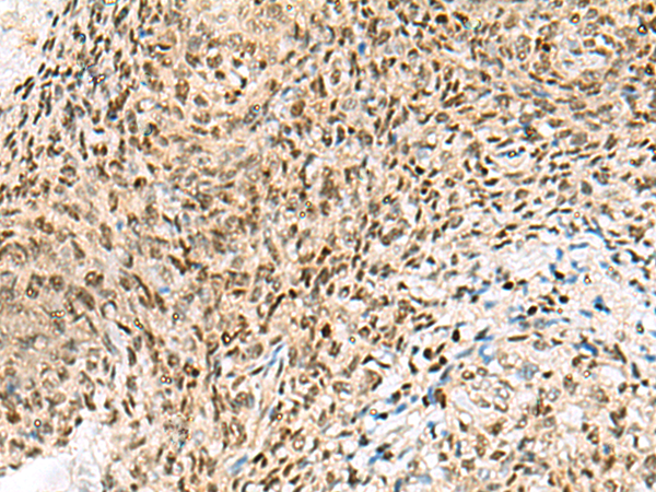 Immunohistochemistry of paraffin-embedded Human cervical cancer tissue  using UBLCP1 Polyclonal Antibody at dilution of 1:85(×200)