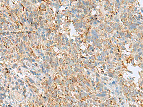 Immunohistochemistry of paraffin-embedded Human cervical cancer tissue  using VDAC3 Polyclonal Antibody at dilution of 1:30(×200)