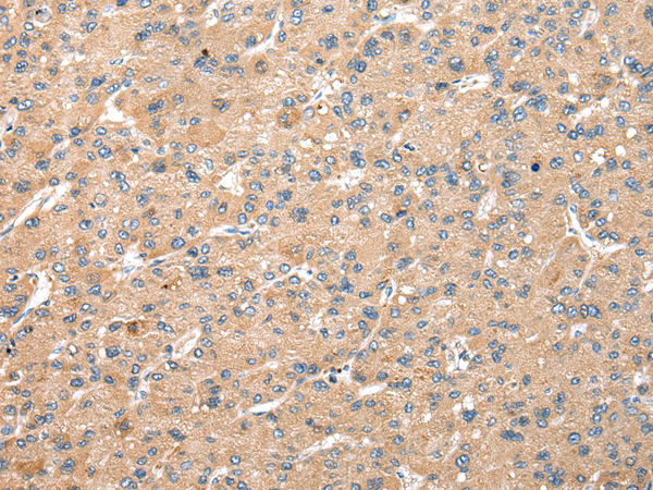 Immunohistochemistry of paraffin-embedded Human liver cancer tissue  using WDR18 Polyclonal Antibody at dilution of 1:25(×200)
