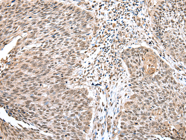 Immunohistochemistry of paraffin-embedded Human lung cancer tissue  using WDR18 Polyclonal Antibody at dilution of 1:25(×200)
