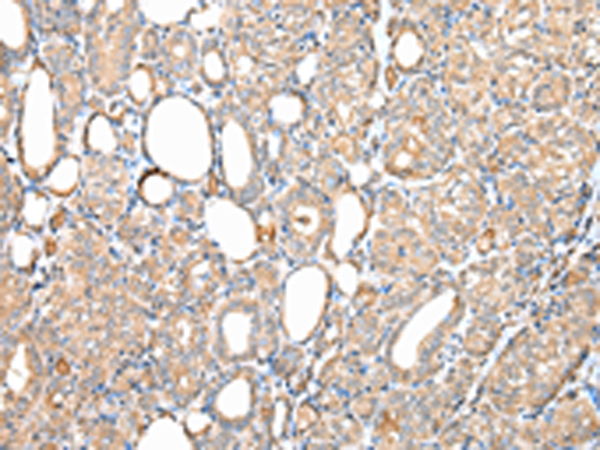 Immunohistochemistry of paraffin-embedded Human thyroid cancer tissue  using DPH7 Polyclonal Antibody at dilution of 1:40(×200)