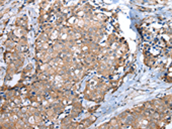 Immunohistochemistry of paraffin-embedded Human breast cancer tissue  using WFDC5 Polyclonal Antibody at dilution of 1:60(×200)