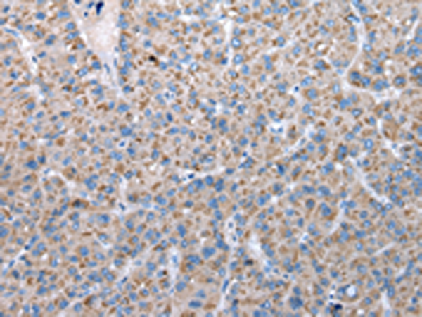 Immunohistochemistry of paraffin-embedded Human liver cancer tissue  using FKBPL Polyclonal Antibody at dilution of 1:50(×200)