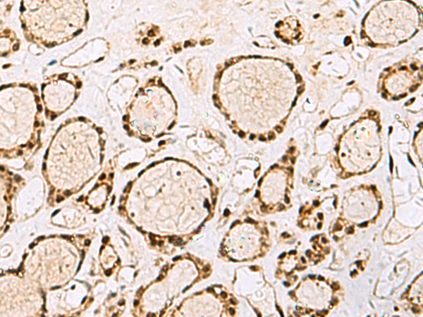 Immunohistochemistry of paraffin-embedded Human thyroid cancer tissue  using XRCC4 Polyclonal Antibody at dilution of 1:60(×200)