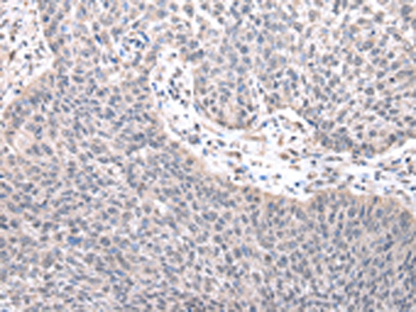 Immunohistochemistry of paraffin-embedded Human lung cancer tissue  using ZNF239 Polyclonal Antibody at dilution of 1:25(×200)