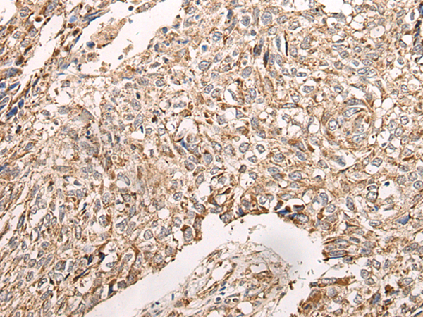 Immunohistochemistry of paraffin-embedded Human lung cancer tissue  using NDUFB11 Polyclonal Antibody at dilution of 1:95(×200)