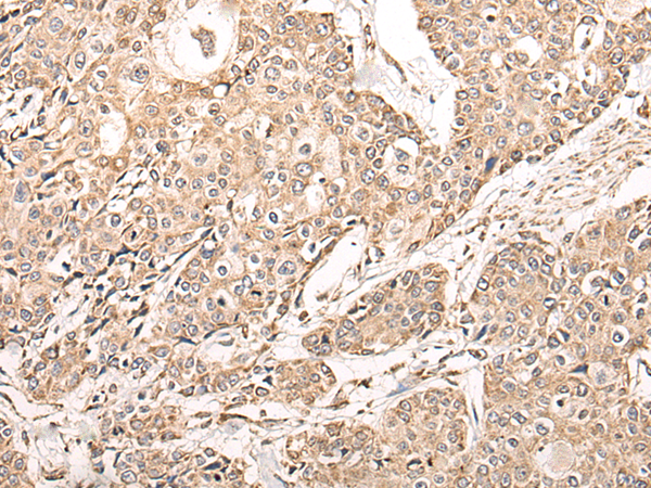 Immunohistochemistry of paraffin-embedded Human prost ate cancer tissue  using NDUFB11 Polyclonal Antibody at dilution of 1:95(×200)