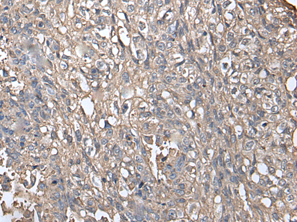 Immunohistochemistry of paraffin-embedded Human lung cancer tissue  using NDUFB5 Polyclonal Antibody at dilution of 1:45(×200)