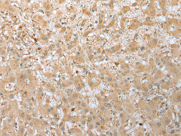 Immunohistochemistry of paraffin-embedded Human liver cancer tissue  using FNDC3B Polyclonal Antibody at dilution of 1:45(×200)