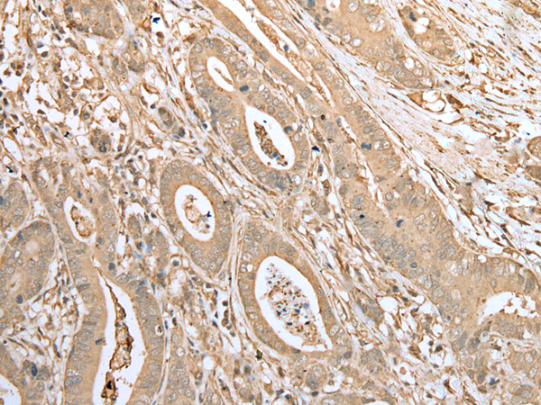 Immunohistochemistry of paraffin-embedded Human gastric cancer tissue  using FNDC3B Polyclonal Antibody at dilution of 1:45(×200)