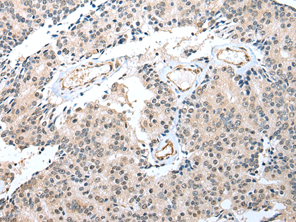 Immunohistochemistry of paraffin-embedded Human prost at e cancer tissue  using S100A16 Polyclonal Antibody at dilution of 1:25(×200)