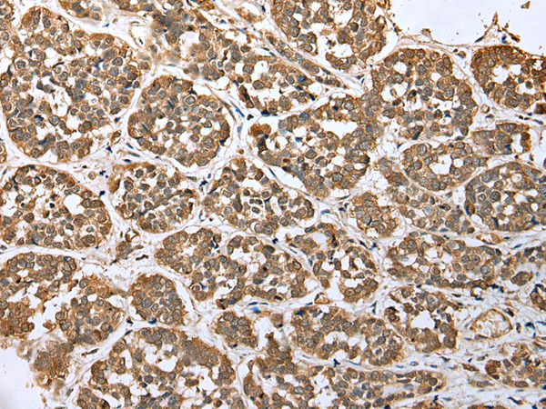 Immunohistochemistry of paraffin-embedded Human esophagus cancer tissue  using ATXN7L3 Polyclonal Antibody at dilution of 1:35(×200)