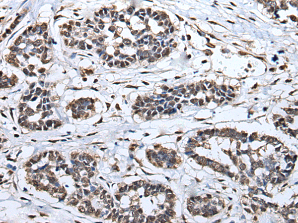 Immunohistochemistry of paraffin-embedded Human esophagus cancer tissue  using HNRNPH2 Polyclonal Antibody at dilution of 1:40(×200)