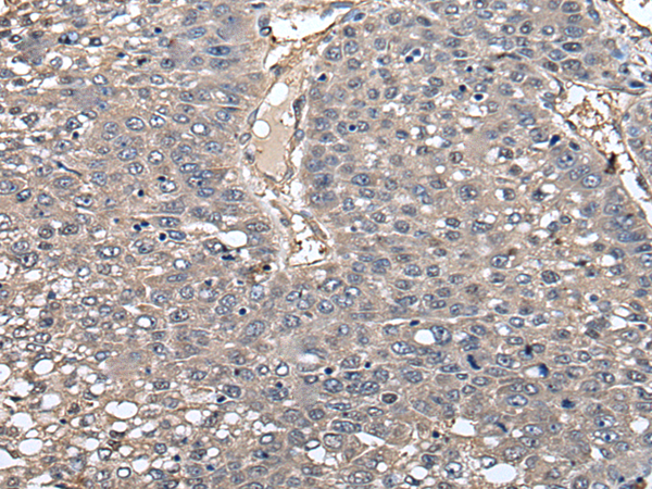 Immunohistochemistry of paraffin-embedded Human liver cancer tissue  using GCNT2 Polyclonal Antibody at dilution of 1:55(×200)