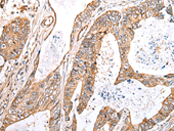 Immunohistochemistry of paraffin-embedded Human colorectal cancer tissue  using KCTD16 Polyclonal Antibody at dilution of 1:30(×200)