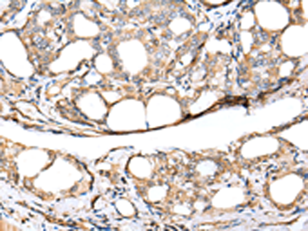 Immunohistochemistry of paraffin-embedded Human thyroid cancer tissue  using KCTD16 Polyclonal Antibody at dilution of 1:30(×200)