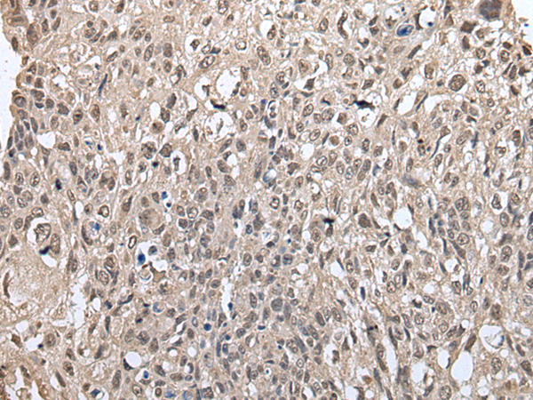 Immunohistochemistry of paraffin-embedded Human lung cancer tissue  using METAP1D Polyclonal Antibody at dilution of 1:60(×200)