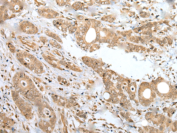 Immunohistochemistry of paraffin-embedded Human gastric cancer tissue  using SPCS2 Polyclonal Antibody at dilution of 1:35(×200)