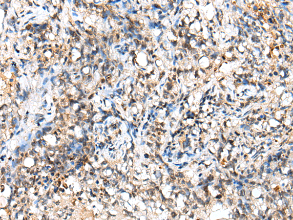 Immunohistochemistry of paraffin-embedded Human lung cancer tissue  using NUDT18 Polyclonal Antibody at dilution of 1:40(×200)