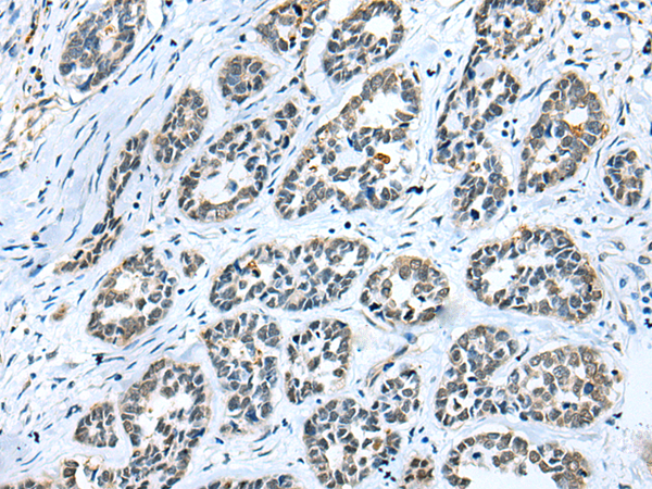 Immunohistochemistry of paraffin-embedded Human esophagus cancer tissue  using GMFB Polyclonal Antibody at dilution of 1:25(×200)