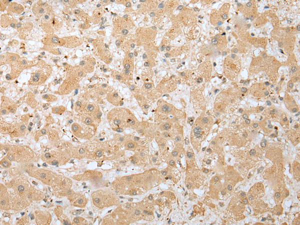 Immunohistochemistry of paraffin-embedded Human liver cancer tissue  using DHRSX Polyclonal Antibody at dilution of 1:30(×200)