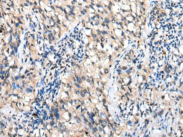 Immunohistochemistry of paraffin-embedded Human lung cancer tissue  using DHRSX Polyclonal Antibody at dilution of 1:30(×200)