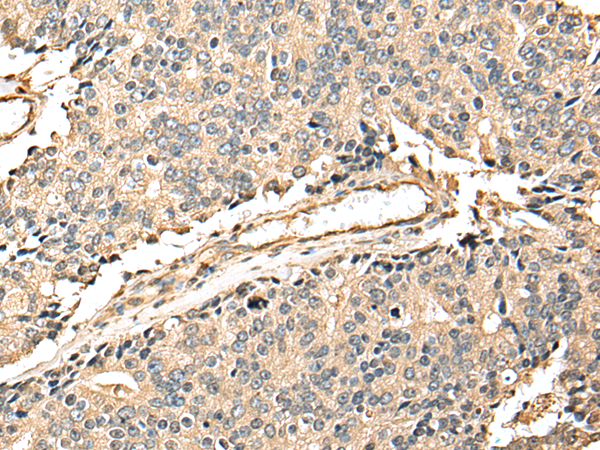 Immunohistochemistry of paraffin-embedded Human prost at e cancer tissue  using EEF1E1 Polyclonal Antibody at dilution of 1:25(×200)