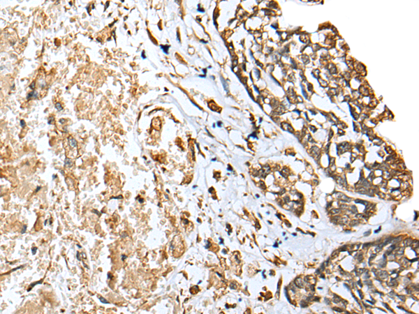 Immunohistochemistry of paraffin-embedded Human esophagus cancer tissue  using EEF1E1 Polyclonal Antibody at dilution of 1:25(×200)
