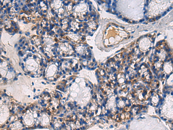 Immunohistochemistry of paraffin-embedded Human thyroid cancer tissue  using ABHD14B Polyclonal Antibody at dilution of 1:60(×200)