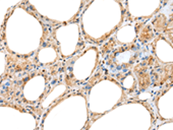 Immunohistochemistry of paraffin-embedded Human thyroid cancer tissue  using RAB11A Polyclonal Antibody at dilution of 1:45(×200)